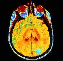 Imaging of a brain tumor 